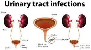 Urinary Tract Infection Treatment in Matunga 