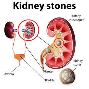 Treatment for Kidney Stones at Matunga 